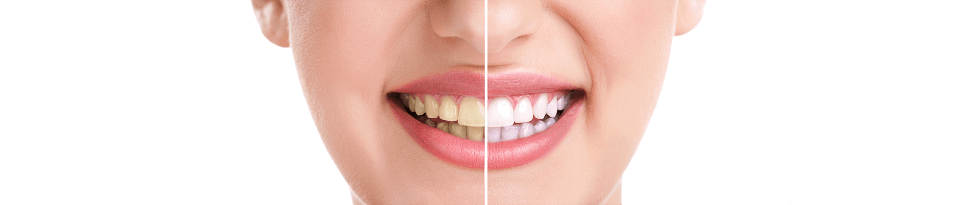 Teeth Whitening in Roseville, California